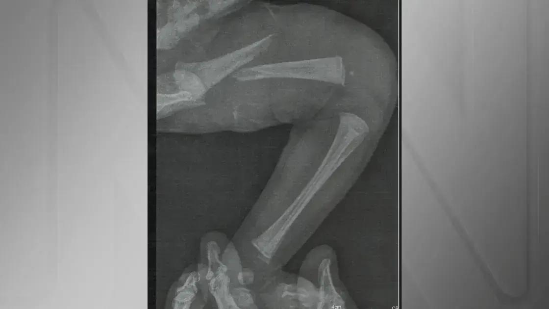 Bebê De 9 Dias Fratura Fêmur Após Falha No Teste Do Pezinho