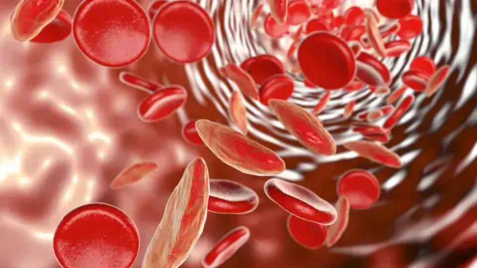 Entenda a Anemia Falciforme: O Que É e Quais São os Sintomas