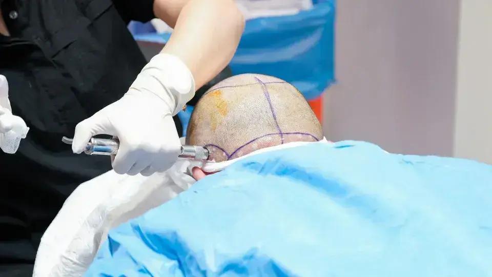 Homem morre na Turquia durante procedimento de transplante capilar